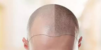 hair transplant course india